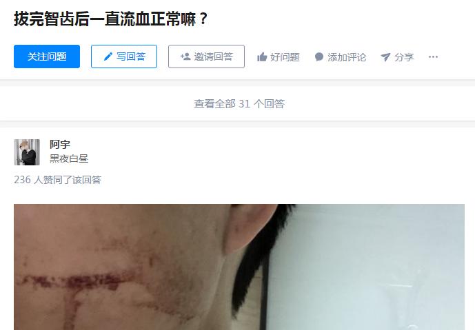 拔智齿出血过多导致死亡,智齿拔牙后流血止血妙招