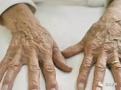 怎么预防老年斑和祛除老年斑,如何治疗手上长老年斑