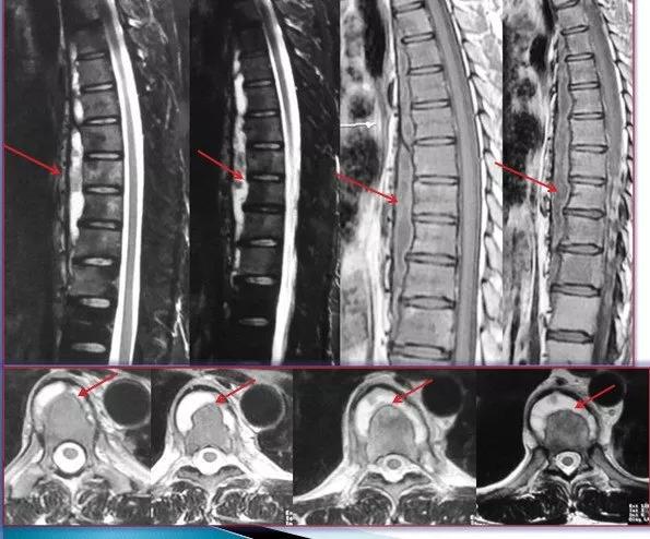 脊柱结核保守治疗大约需要多少钱,脊柱结核可以保守治疗