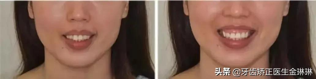 成年人露龈笑怎么矫正,如何矫正露龈笑嘴突
