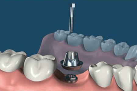 种植牙第一次拆线后的步骤,种植牙二期修复取模的步骤