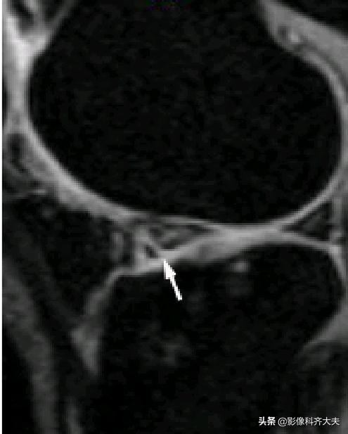 膝关节半月板损伤的磁共振,膝关节半月板病变的mri诊断与鉴别