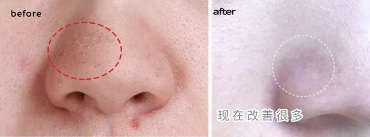 专治螨虫的洗面奶,螨虫专用洁面乳