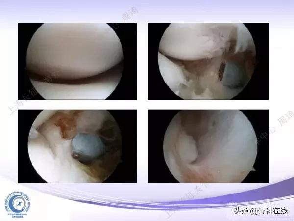 肘关节镜手术后引流,肘关节镜微创手术