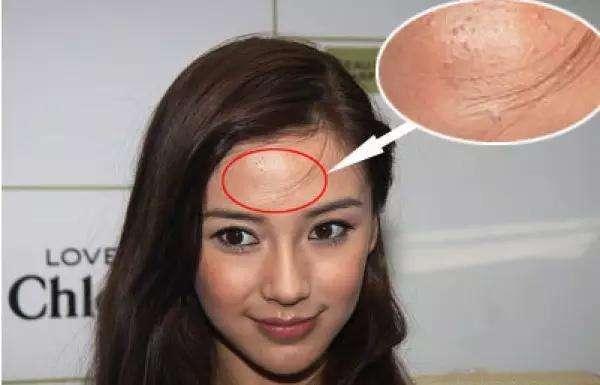 闭合性粉刺到底有多难治？看完本文你就完全清楚了