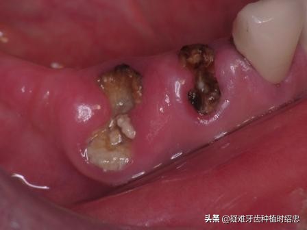 只剩残根的牙真的能补救吗,烂的只剩下黑色残根的牙怎么处理