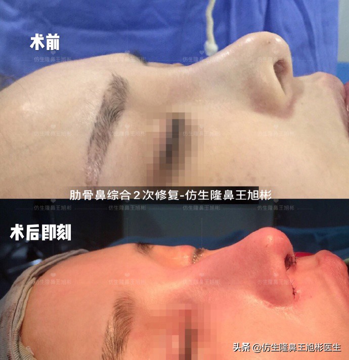 隆鼻的鼻翼怎么修复,隆鼻后多久可以做鼻翼缘矫正