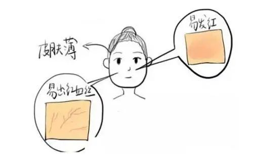 洗脸搓破了表皮会留疤吗,为什么洗脸之后总是有白色角质