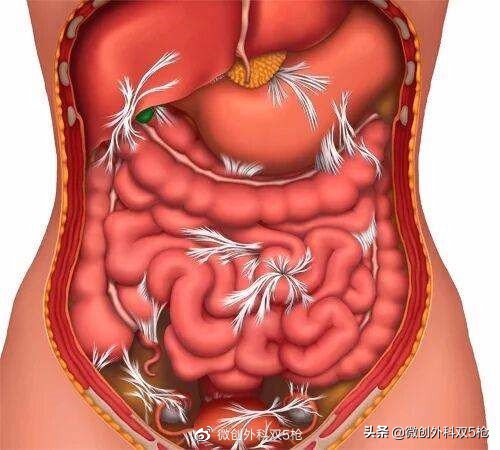 阑尾炎症状是什么部位痛,阑尾炎是什么样的疼