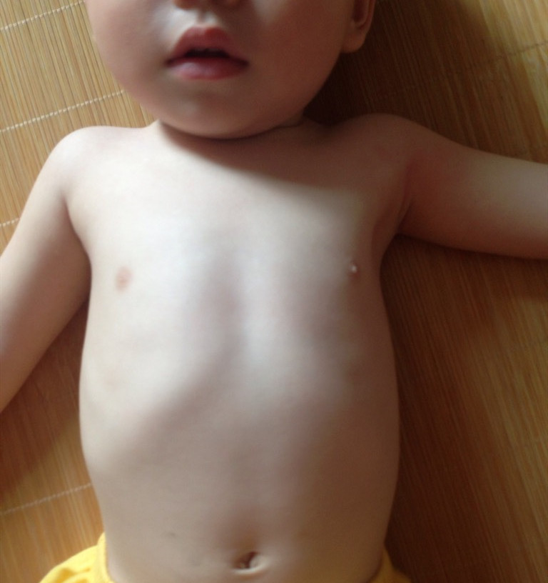 鸡胸体型怎样矫正,孩子长鸡胸该怎么办