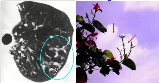 肺部ct十大征象,肺部ct正常图和异常图的区别