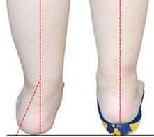 脚底疼痛警惕四种病,脚底疼痛怎么处理