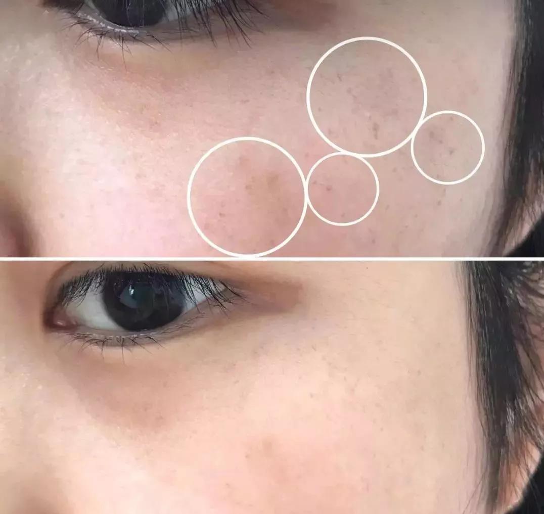 祛色斑的小窍门,色斑严重学会这几招省钱又有效