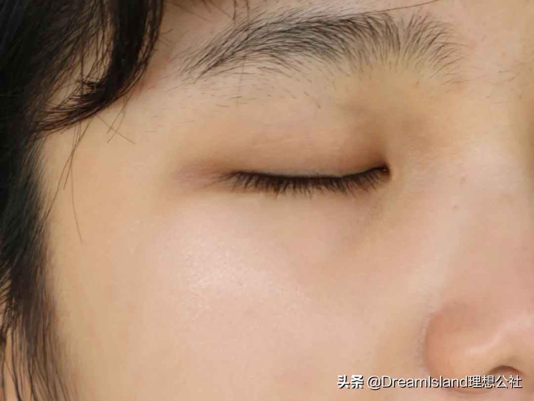 玻尿酸高光排名,打玻尿酸高光推荐