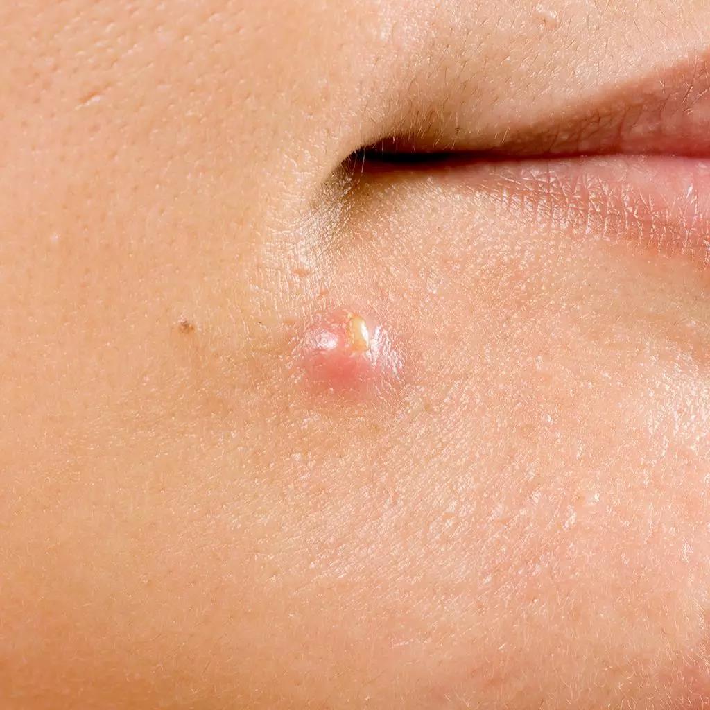 才清完痘痘要怎么护理皮肤,痘痘类皮肤的护理方法有哪些