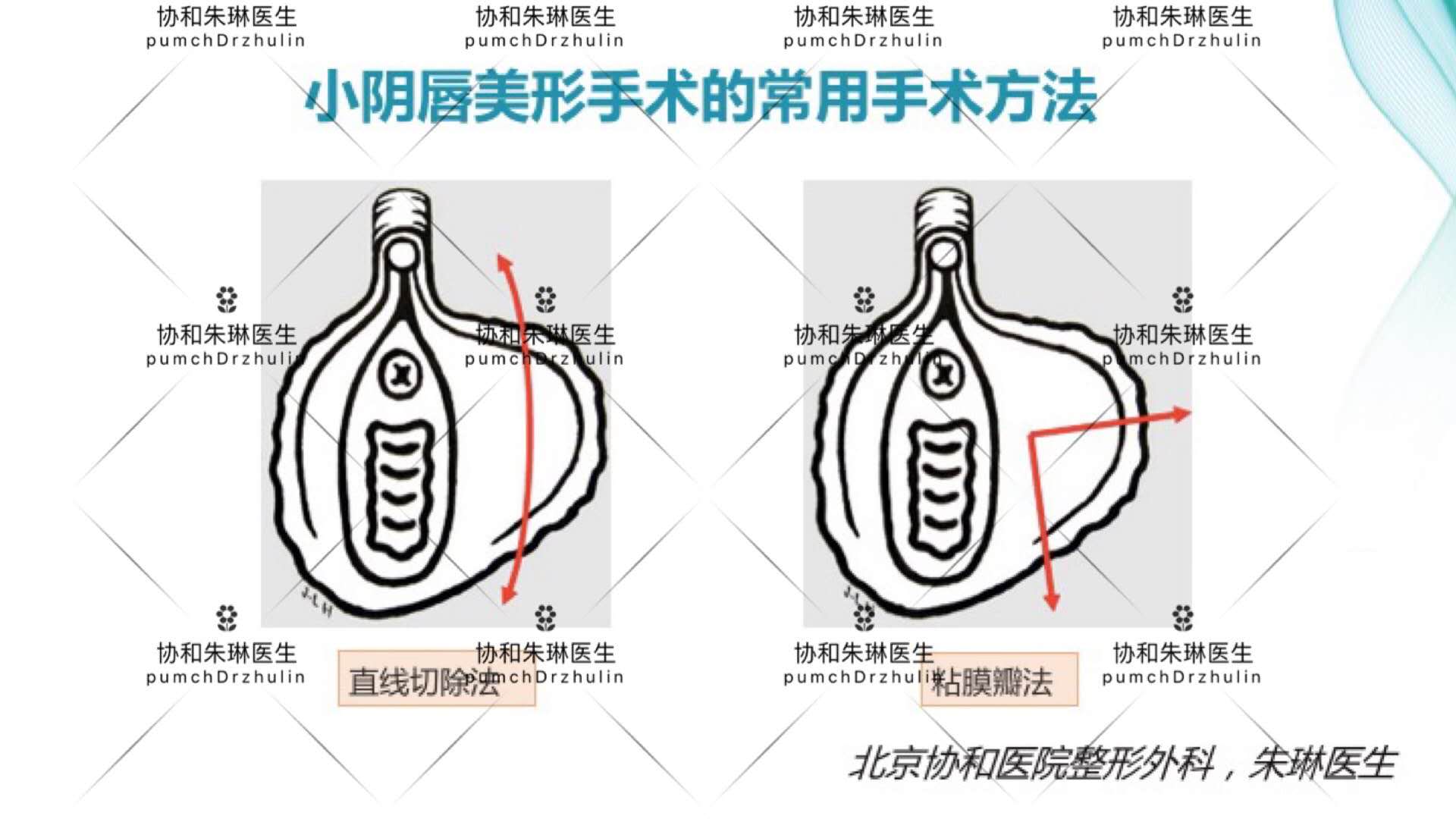 外阴一边大一边小手术怎么做,外阴不规则可以做手术吗