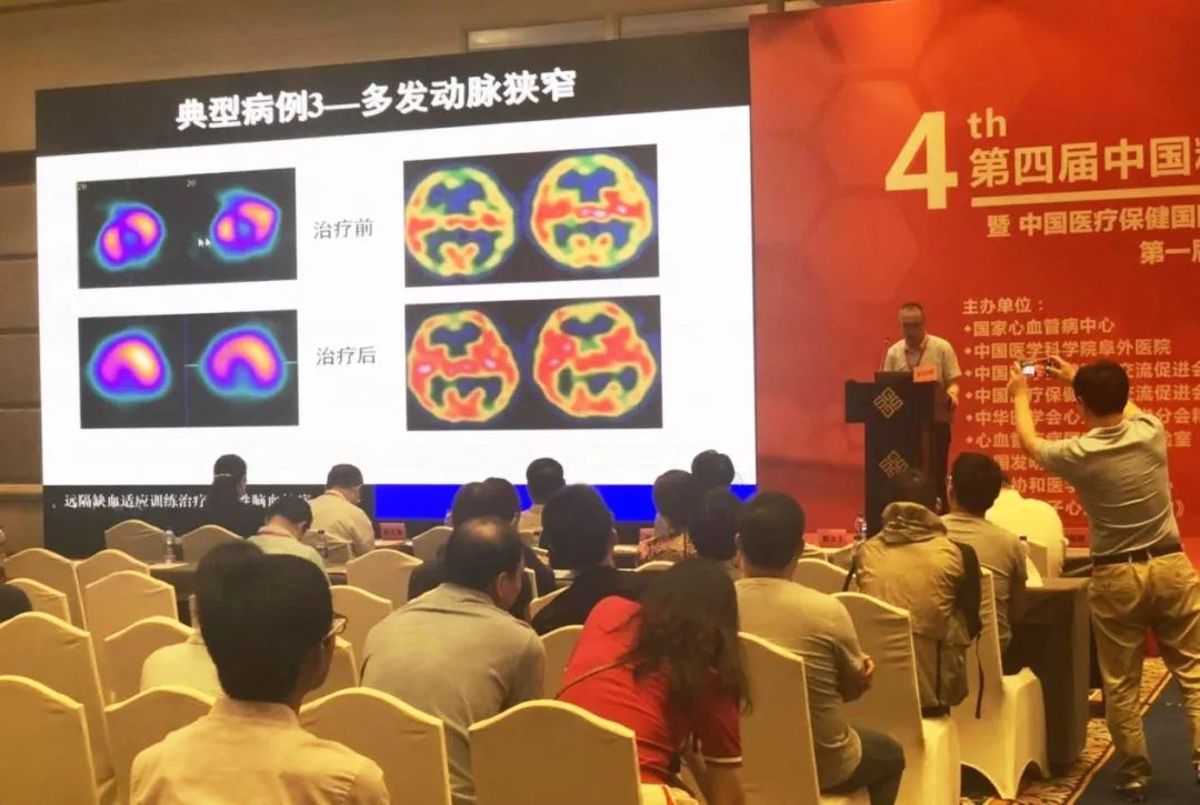 吉训明缺血适应训练怎样做,吉训明的缺血预适应疗法咋样