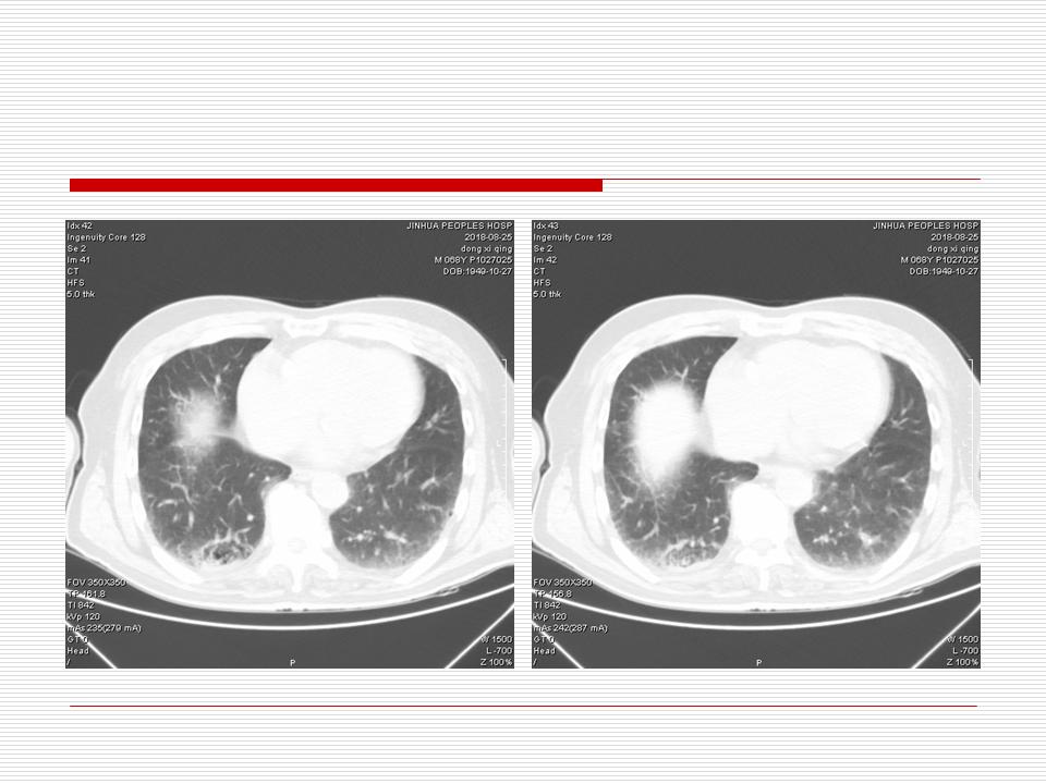 像炎症的肺癌能治好吗,医生说可能是肺癌也可能是炎症