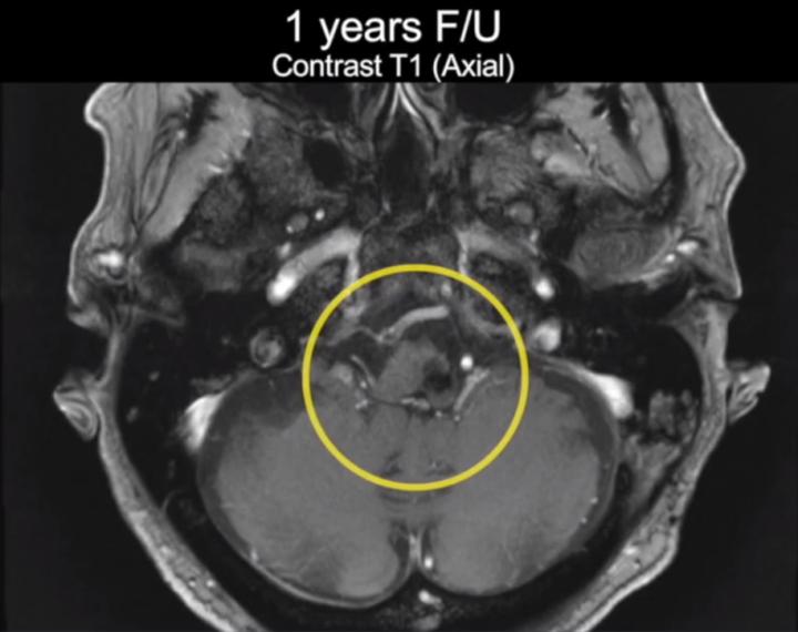 脑干海绵状血管瘤开颅手术,脑干做手术的示意图