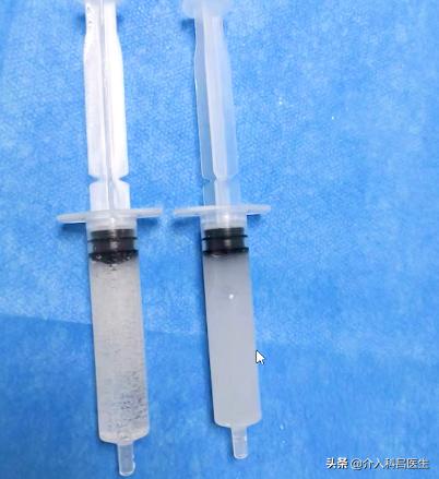 她因为子宫肌瘤贫血，差点切除子宫！还好新型疗法帮了她