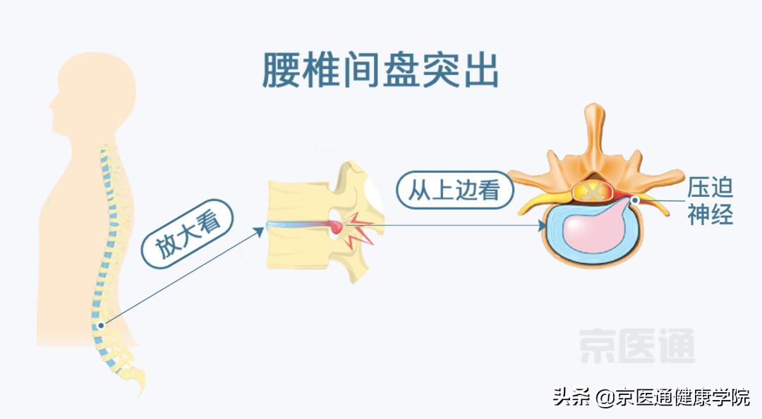 腰痛、腿痛是什么病？骨科医生用一块「羊蝎子」告诉你