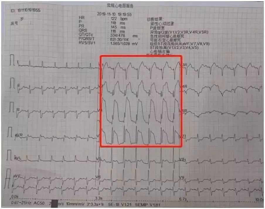 足球球员心脏骤停抢救成功案例,足球赛老人心脏骤停