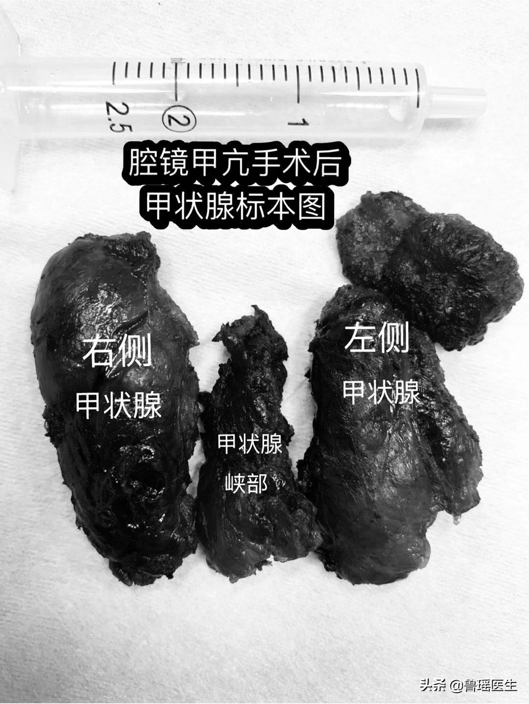 舞蹈老师患上甲亢，吃药有副作用手术又担心留疤痕，该怎么办？
