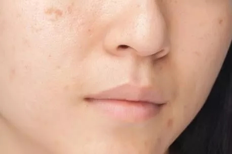 片仔癀护肤品去斑有效吗,片仔癀的护肤品祛斑吗