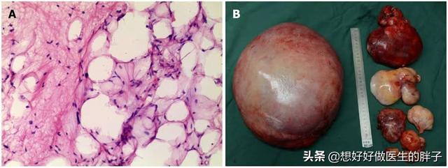 胃脂肪瘤有恶变吗,小肠脂肪瘤恶变吗