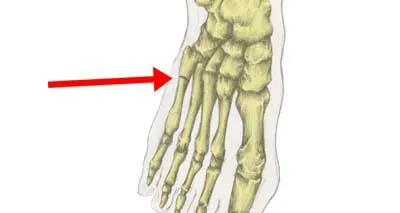 前脚掌疼痛,前足疼