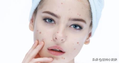 脸上长痘痘身上长痘的原因,脸上平常不长痘痘突然长痘痘