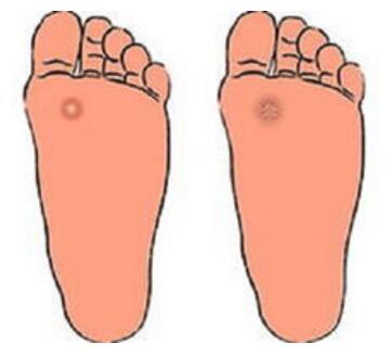 得了皮肤病千万别碰这些药,别把体癣当湿疹