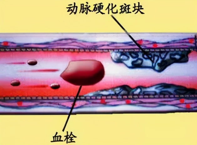 动脉斑块会掉下来吗？坦白说：不会！但导致斑块的危险因素要警惕