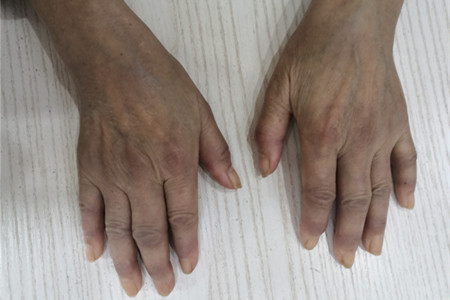 再难治的类风湿也能治好,类风湿治不好