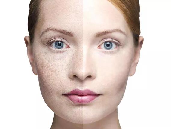 点阵激光祛痘印的副作用和危害,做点阵激光手术有什么危害