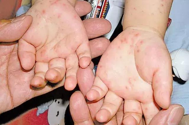 春季是各种传染病的高发季,春季是传染病的高发期吗