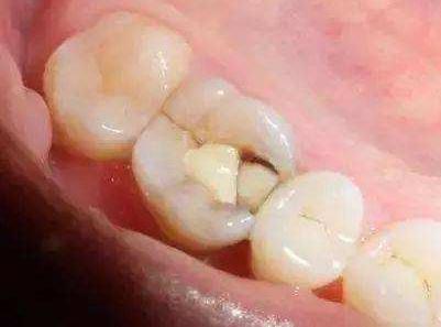 补过的牙还能洗牙吗？什么样的人不适合洗牙？洗牙之前要弄清楚