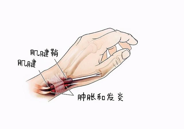 得了妈妈手——腱鞘炎，真的需要封闭治疗吗？杨大夫为你揭秘