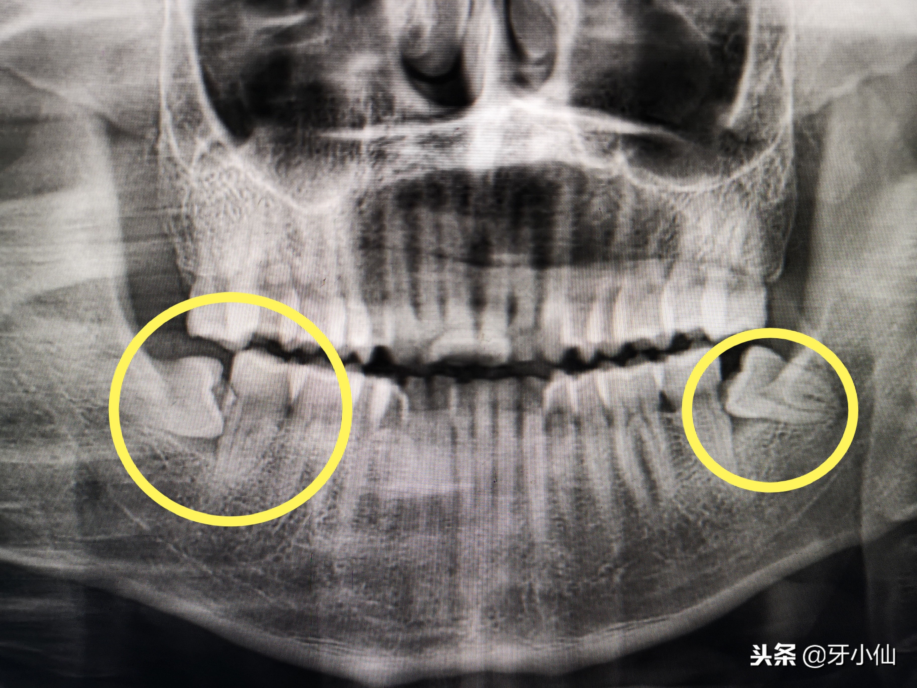 拔牙后真疼啊,拔牙后一般会疼多久