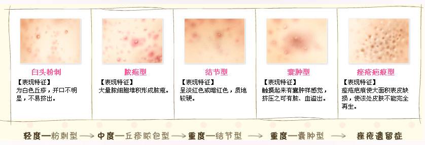 四年痘龄的祛痘心得体会