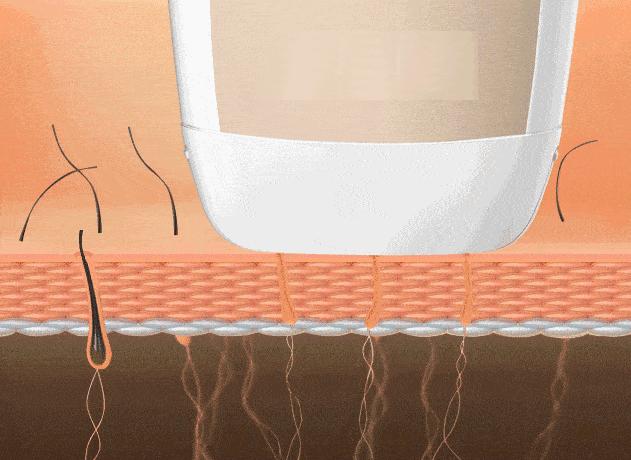 多毛用什么脱毛方法效果好,毛多如何脱毛