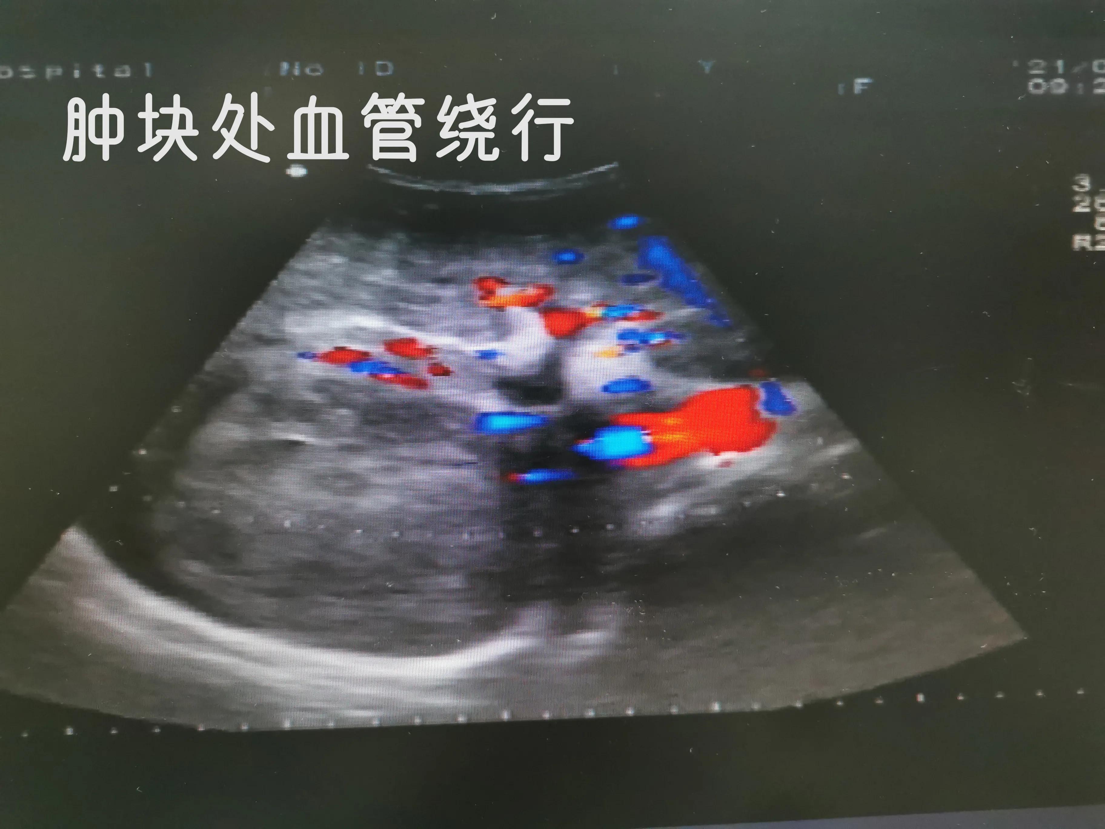 乙肝肝硬化和丙肝肝硬化的区别,乙肝肝硬化肝部占位是肝癌吗