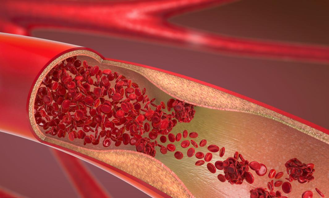 心血管造影显示堵80%,病人该如何选择治疗?可先溶栓、后放支架