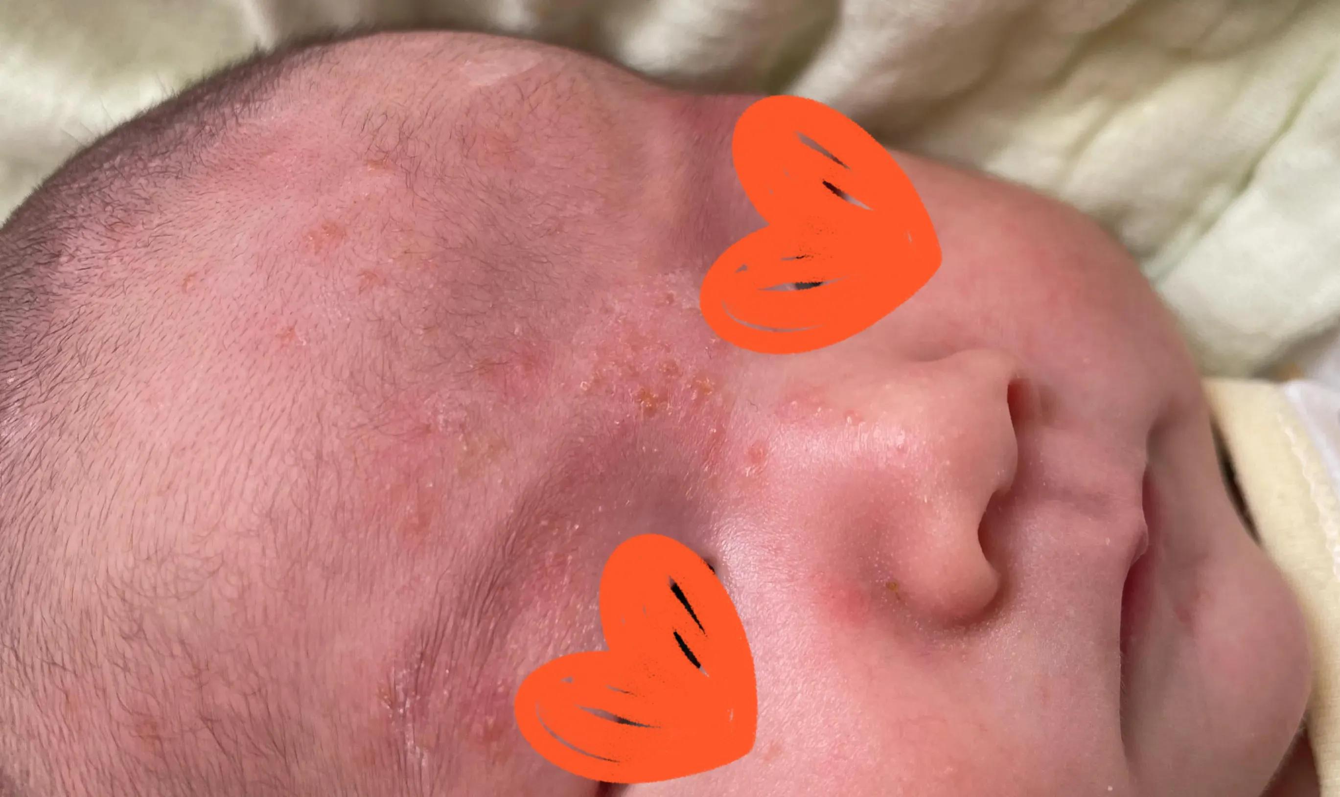 养宠物会不会造成孩子湿疹,孩子有干性湿疹能养宠物吗