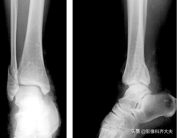 骨折的影像学检查及各自的优势,骨折的影像学愈合标准