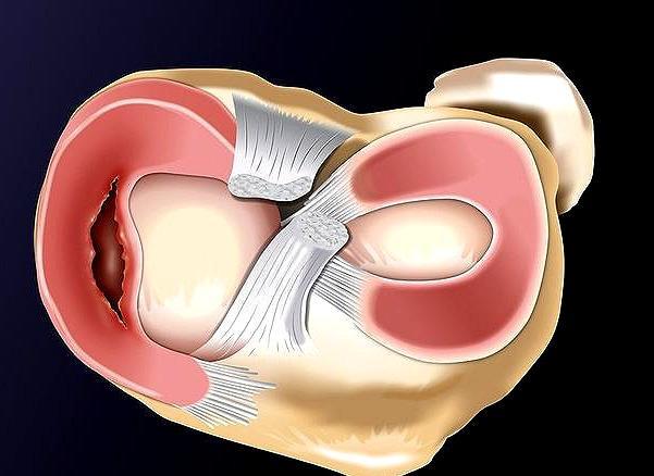 半月板撕裂要不要去修复,内侧半月板撕裂会切除多少半月板