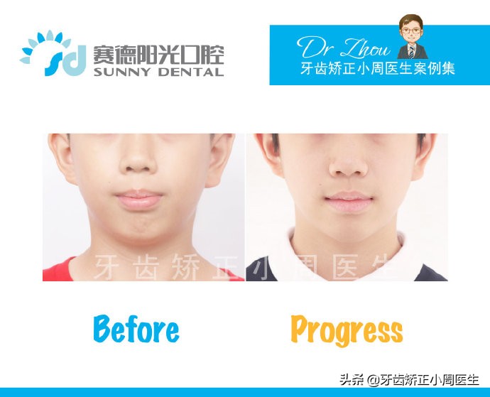 下巴后缩整容玻尿酸还是假体,如何不靠整容改变下巴