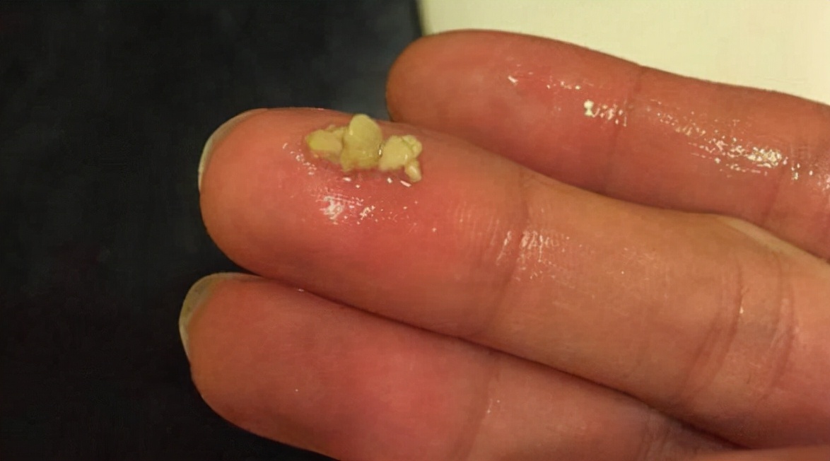 六岁男孩口臭严重,6岁男童口臭