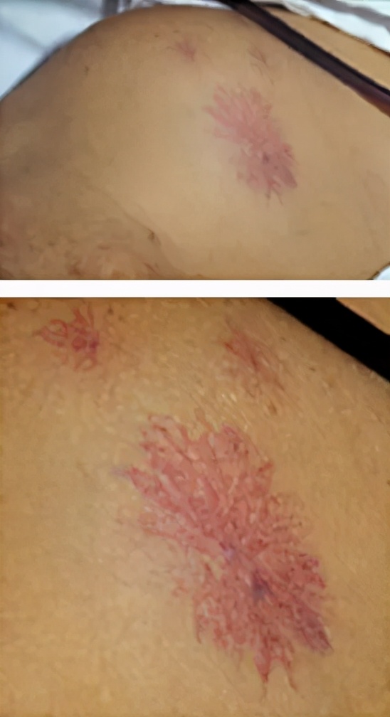 身上长了红色的蜘蛛点怎么回事,身上有蜘蛛红点