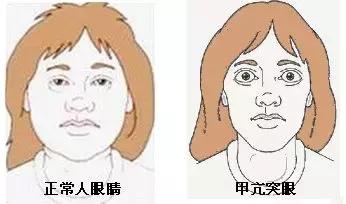 甲亢药物治疗期间甲减停药,甲亢吃药期间应注意什么